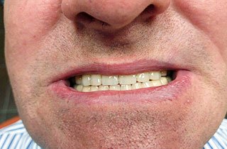 dental immediate implants less cheaper requires ihde treatment materials because traditional than